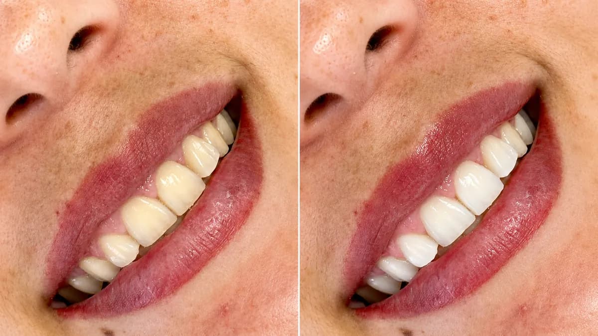 Clareamento dental