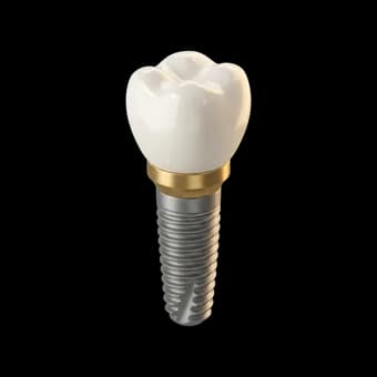 Implantes Dentários